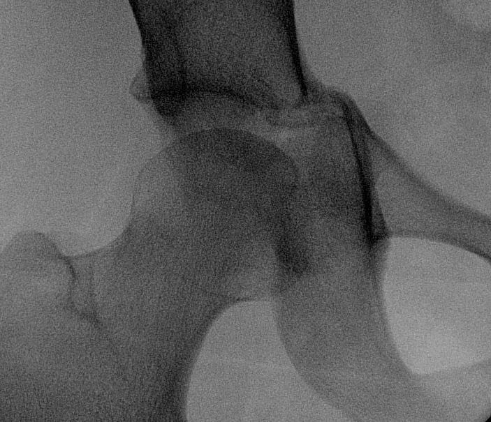 Acetabular Fracture Post Steinman Pin